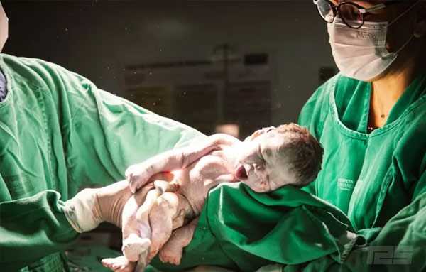 acidos-graxos-presentes-do-cordao-umbilical-podem-ser-causa-do-autismo,-revela-estudo